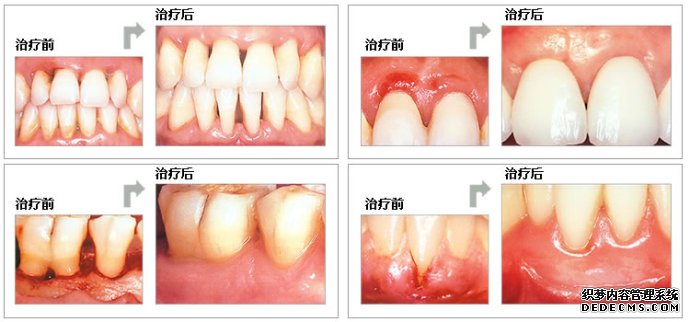 武汉牙周病治疗